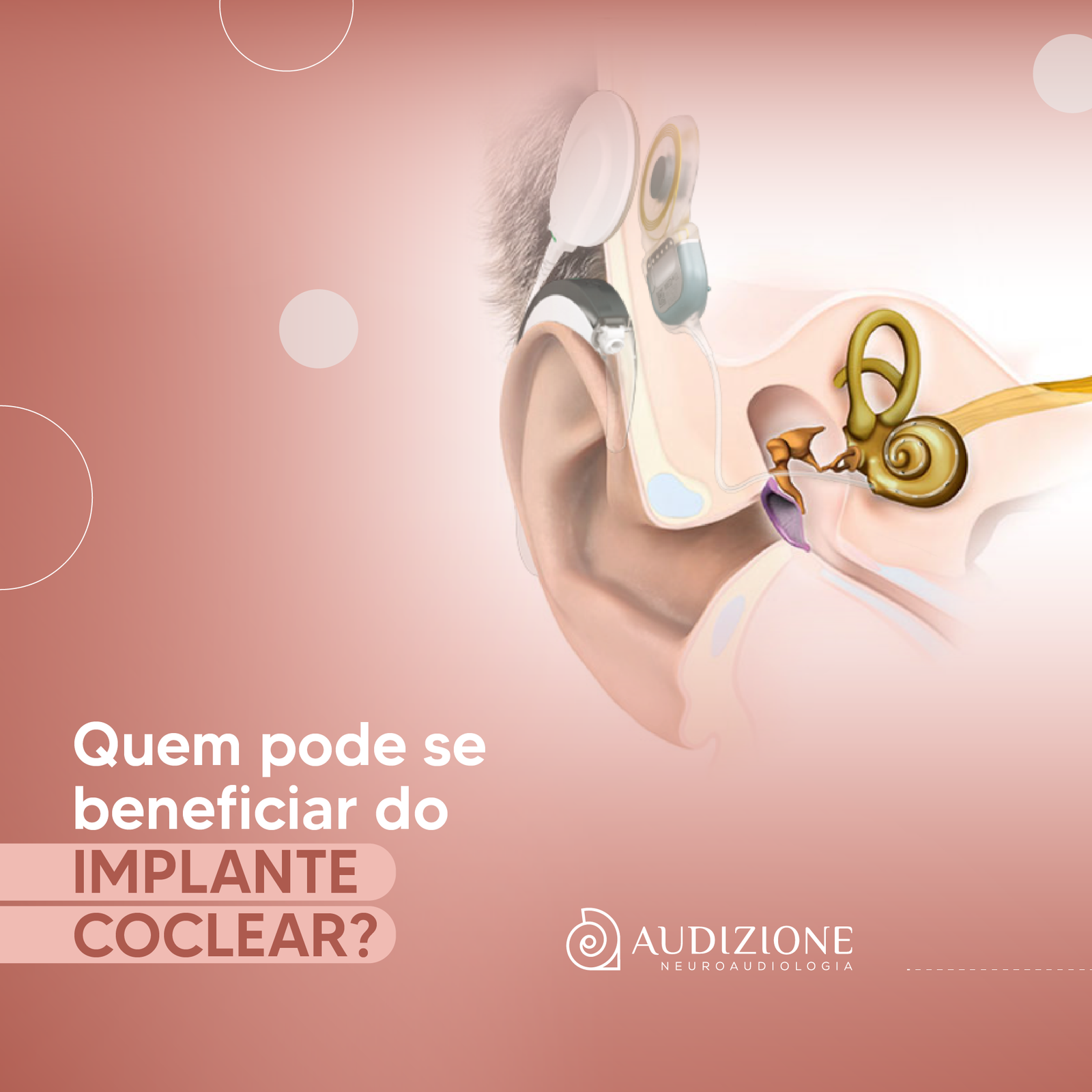 Quem pode se beneficiar do IMPLANTE COCLEAR?